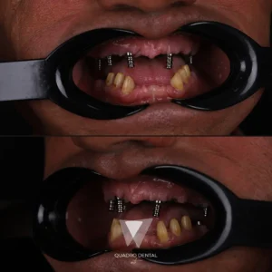 Nahaufnahme eines Patienten mit sichtbaren Implantaten vor der endgültigen Zahnrestauration bei Quadro Dental.