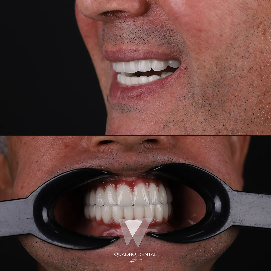 Lächelnder Patient nach erfolgreicher Zahnimplantat-Behandlung bei Quadro Dental.