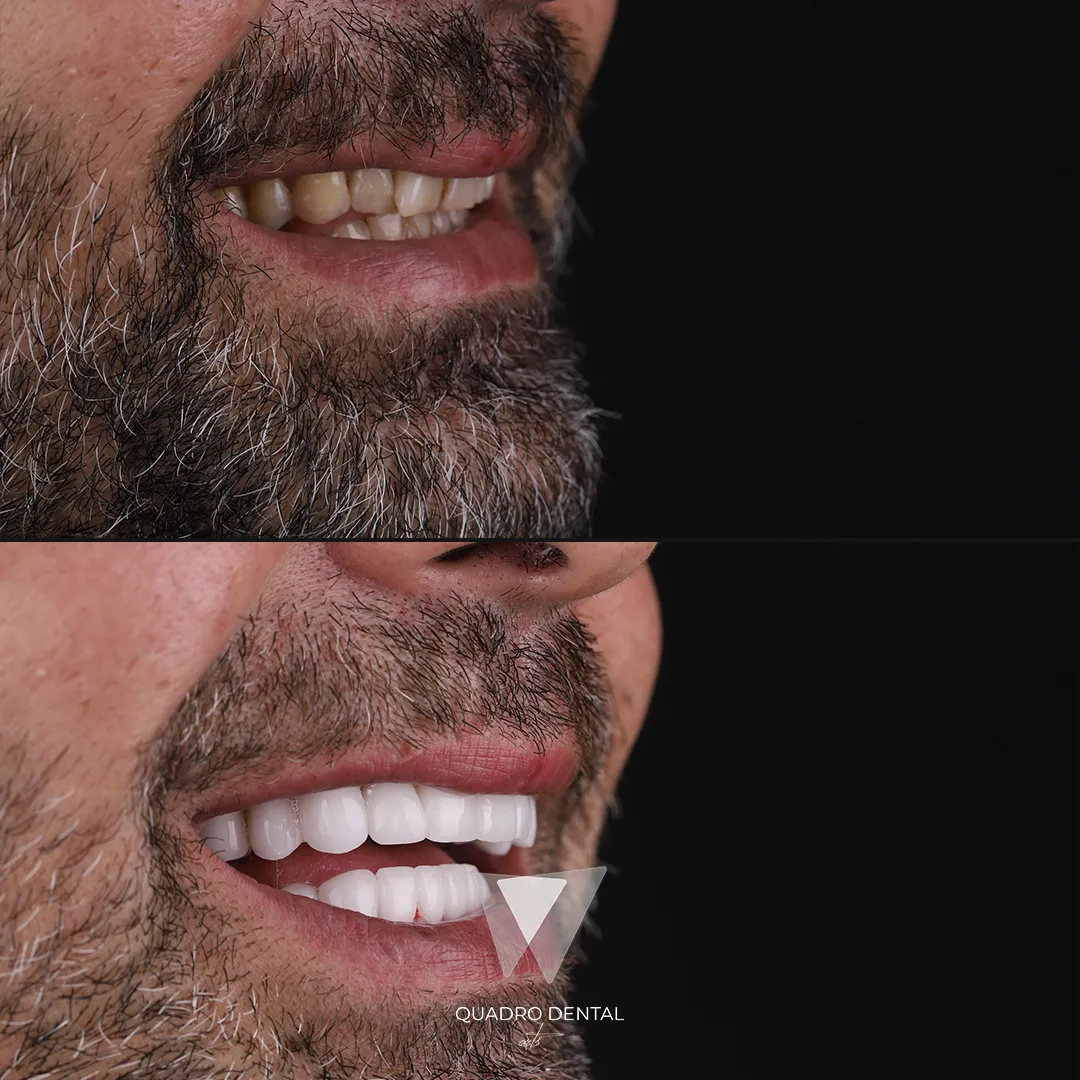 Vorher-Nachher Zahnbehandlung bei Quadro Dental