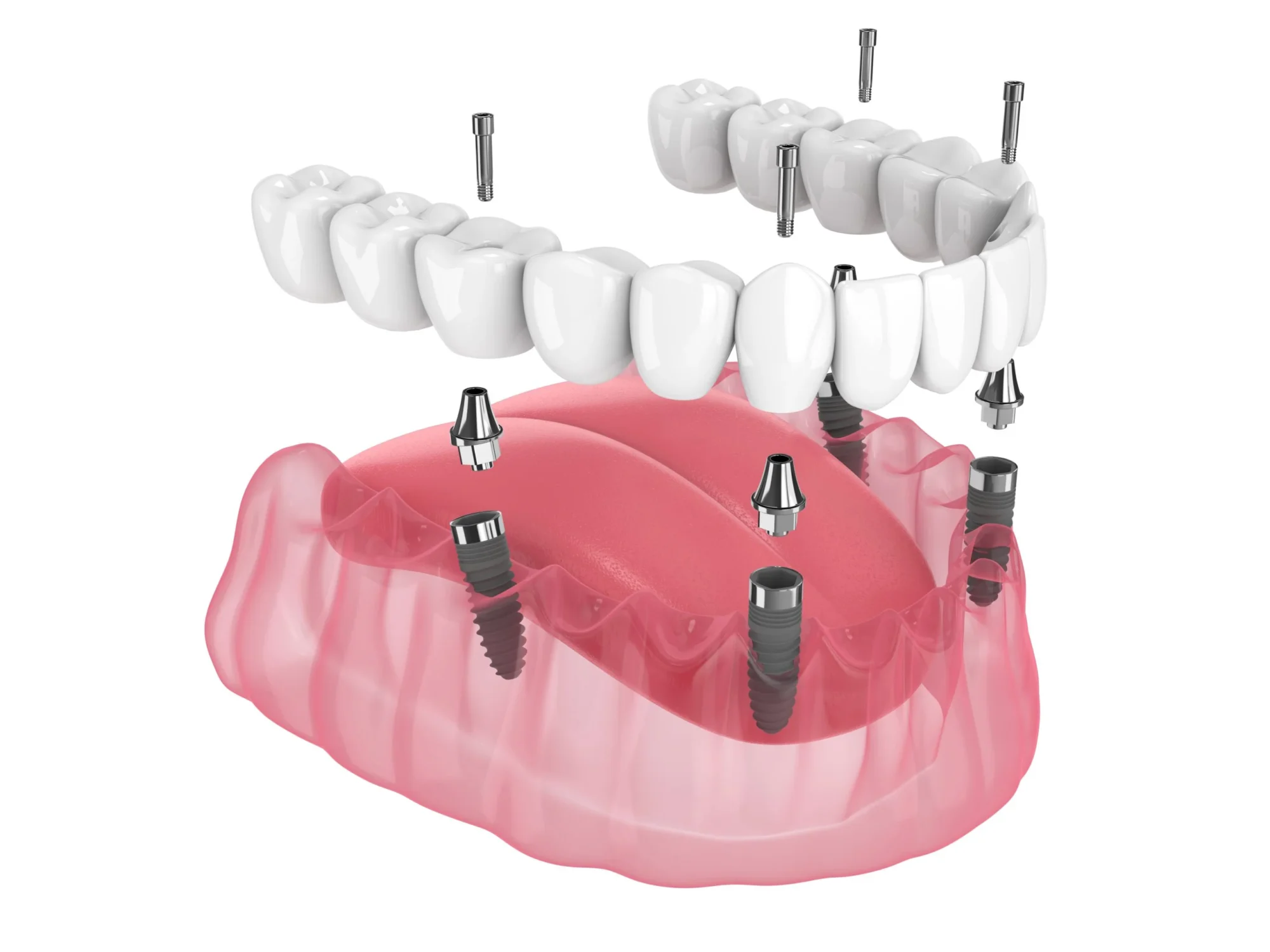 All on 4 Zahnimplantate bei Quadro Dental