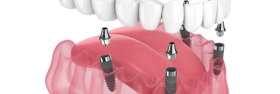 All on 4 Zahnimplantate bei Quadro Dental