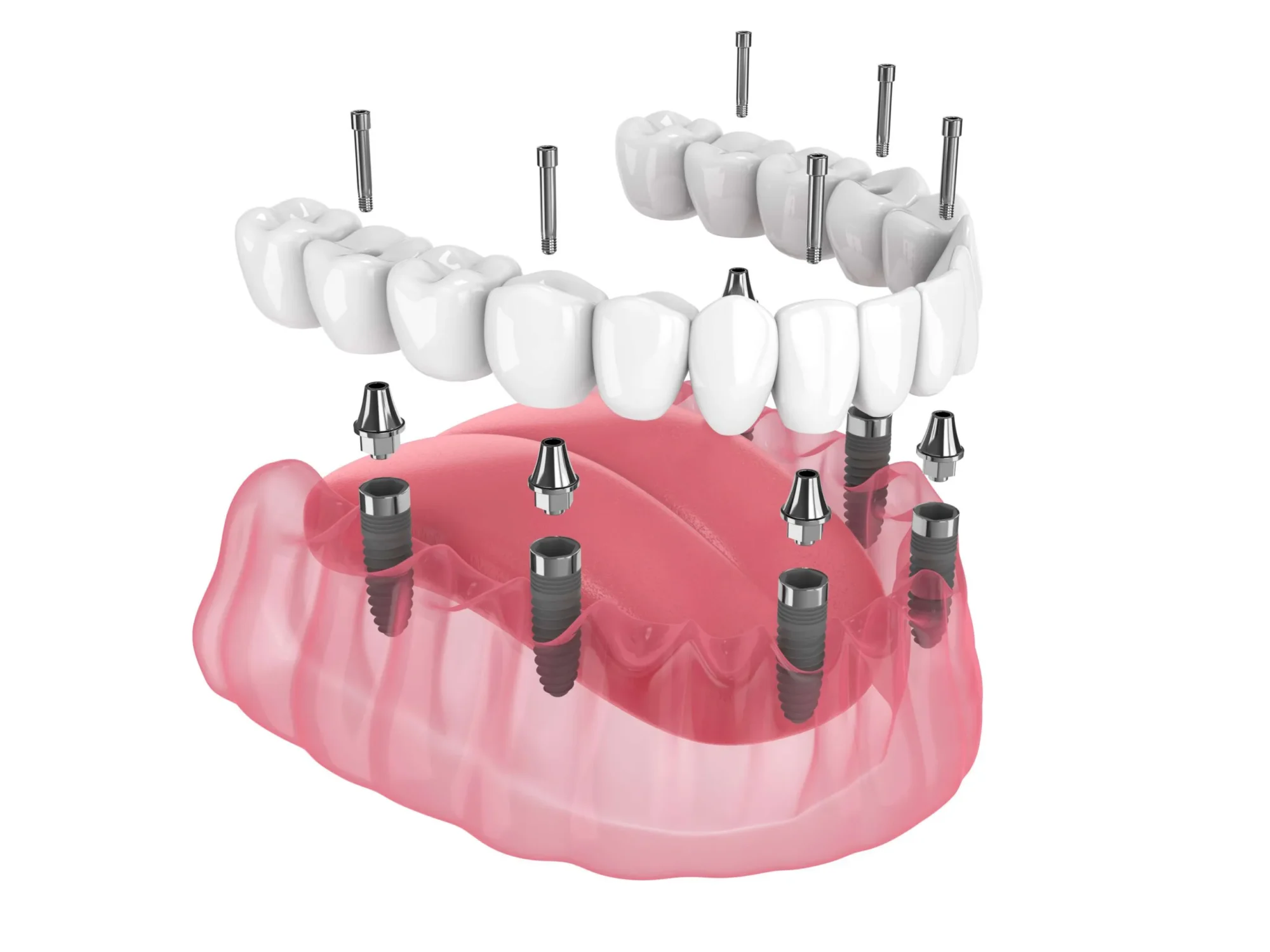 All on 6 Zahnimplantate bei Quadro Dental